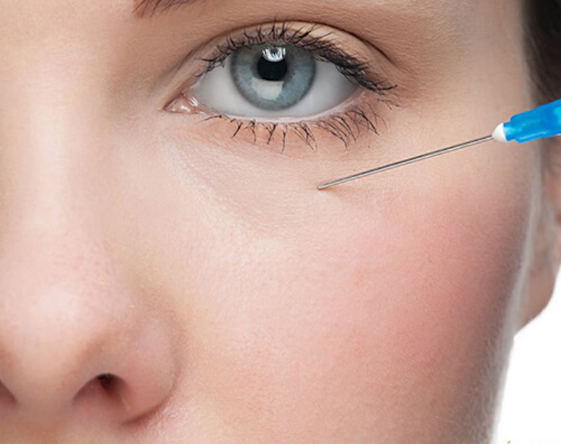 Tiêm filler hốc mắt có nguy hiểm không?