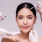 Tiêm filler làm đầy thái dương là gì?