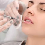 Tiêm filler môi giữ được bao lâu? Bật mí bí quyết giúp môi bền dáng, mềm tự nhiên