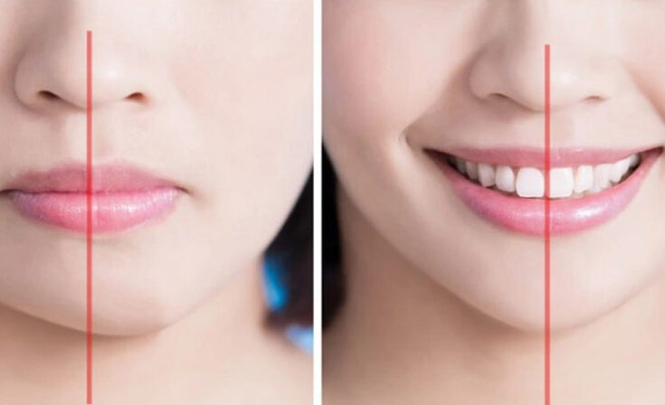 vien moi bi lech la gi e1760944839587