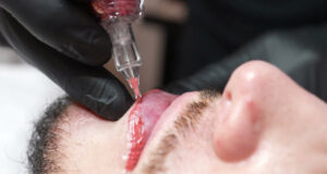 Khử thâm môi nam bằng công nghệ Nano Collagen là gì?