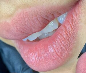 Khử thâm môi là gì?