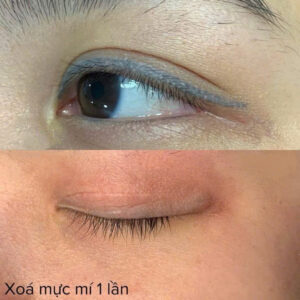 Công nghệ laser mới giúp xoá phun mí lỗi ra sao?