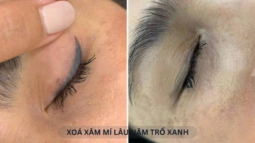 Công nghệ laser mới giúp xoá phun mí lỗi ra sao? 6 z7099670857004 a05c46a81968f58b9e2a687aeec8e23e