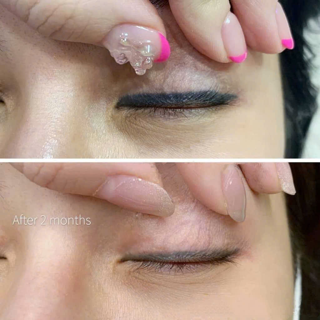 Công nghệ laser mới giúp xoá phun mí lỗi ra sao? 7 z7099670863370 9038f1182a3bf63862ea3a2a7afd29ee