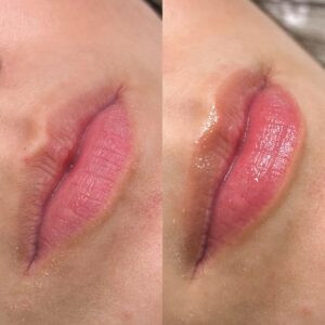 Khử thâm môi nhanh có đau không? Quy trình và hiệu quả chi tiết