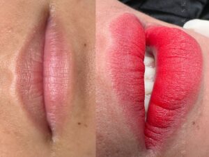 khử thâm môi nhanh cho môi thâm bẩm sinh