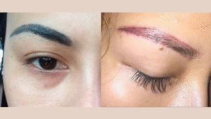 Chân mày bị trổ xanh/đỏ – nguyên nhân & cách sửa triệt để tại Thẩm mỹ Bảo Anh