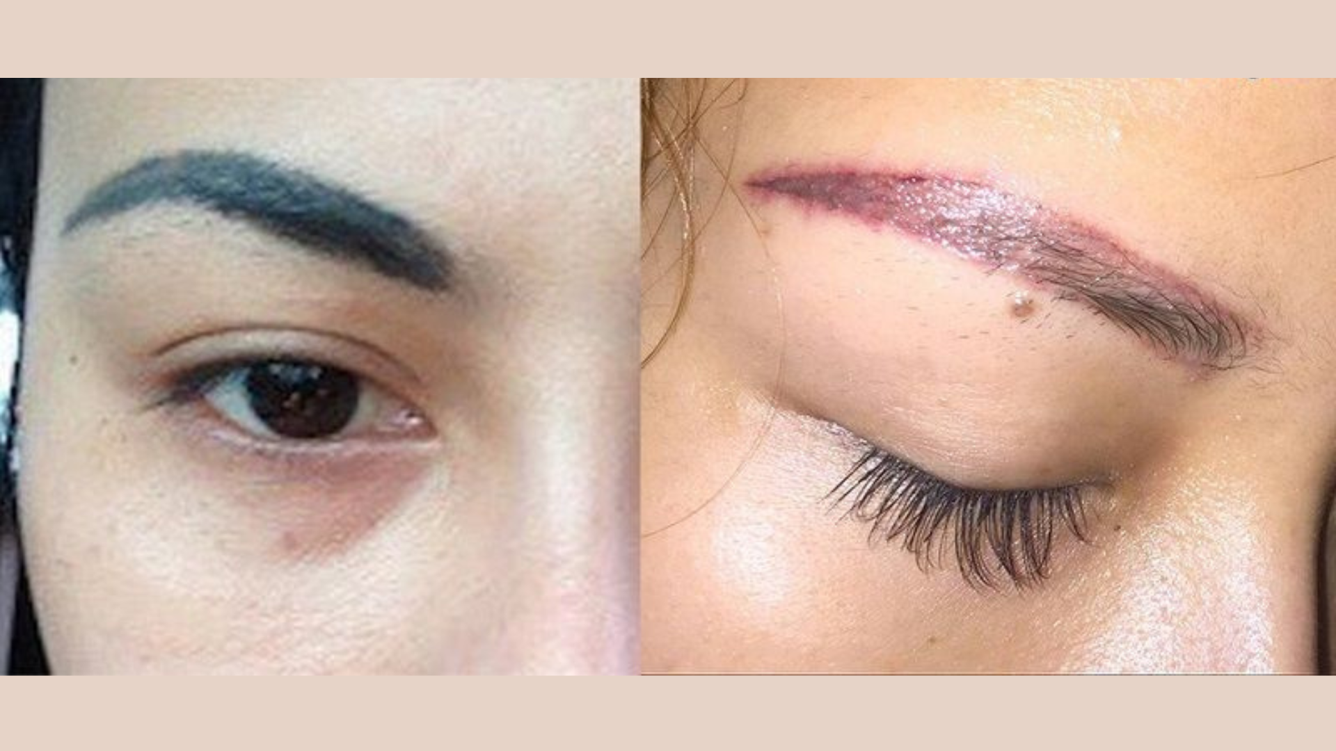 Chân mày bị trổ xanh/đỏ – nguyên nhân & cách sửa triệt để tại Thẩm mỹ Bảo Anh