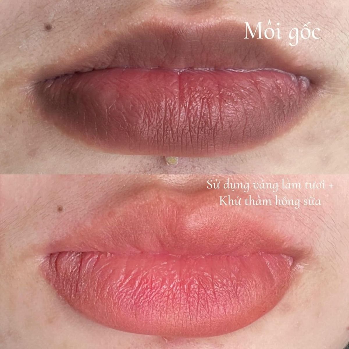 Khử thâm môi nhanh hiệu quả: bí quyết lên màu đều, không sưng đau 6 khử thâm môi nhanh
