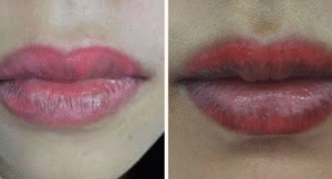 ly do moi bi tham sau phun xam e1764157227755