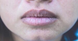 Môi thâm nặng: bao lâu thì lên màu?