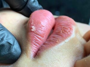 Quy trình phục hồi môi sau phun xăm cho người mới làm lần đầu