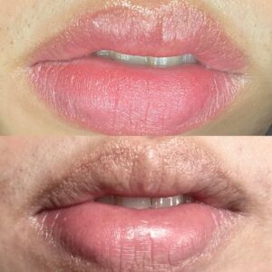 Khử thâm môi có hết hẳn không? Sự thật chuyên gia không nói rõ