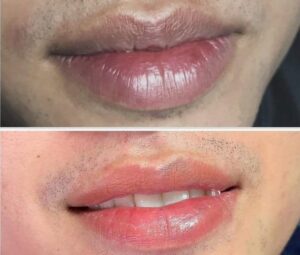 Khử thâm môi là gì? Phương pháp nào an toàn và hiệu quả nhất hiện nay