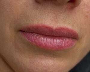 Phun môi bị thâm sau bong