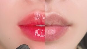 Phun môi có hết thâm hoàn toàn không?