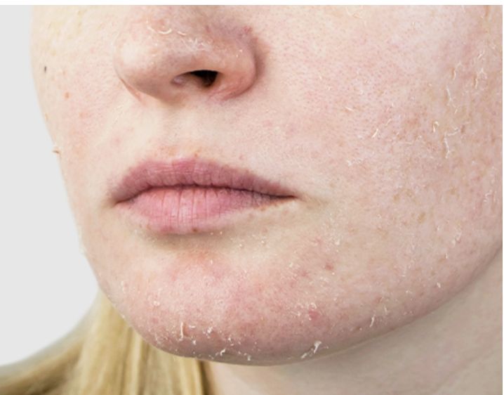 Phun mày Ombre có phù hợp với mọi loại da không? 2 Chăm sóc cho da khô sau phun mày môi 2026: Hướng dẫn giúp màu lên đều-đẹp-tự nhiên