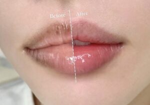 Khử thâm môi có đau không? Thời gian hồi phục bao lâu là bình thường