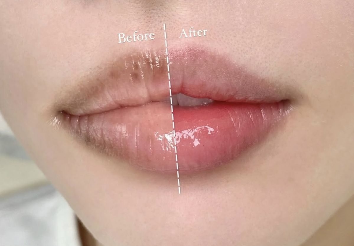 Khử thâm môi có đau không? Thời gian hồi phục bao lâu là bình thường