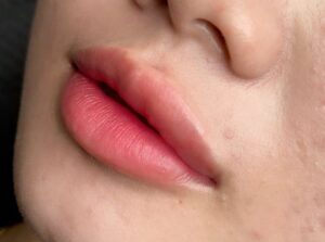 Khử thâm môi công nghệ nào cho kết quả nhanh và bền màu?