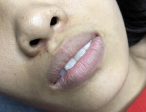 Môi thâm có phun được không? Công nghệ trị thâm 2026