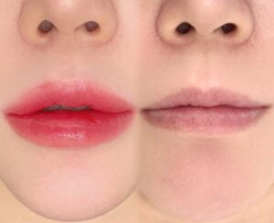 Môi thâm lâu năm có khử được không? Ai nên và không nên làm