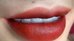 Nhung truong hop phun moi co nguy co de lai seo e1765766976971