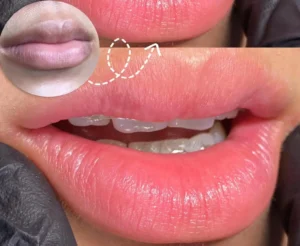 Quy trình khử thâm và phun môi màu hồng đào chuẩn chuyên gia