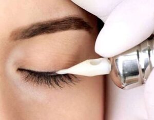 Phun mí có đau không? Hướng dẫn chi tiết 2026