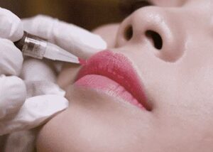 Phun môi bao lâu thì hết sưng? Khi nào là bình thường, khi nào cần đi khám 2 Phun môi bao lâu thì hết sưng? Khi nào là bình thường, khi nào cần đi khám