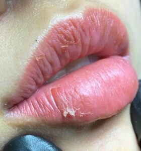 Phun môi bị khô nứt có nguy hiểm không?