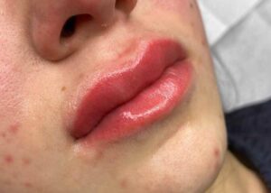 Phun môi bị sưng lâu có sao không? Dấu hiệu cảnh báo biến chứng