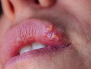 Phun môi có gây nhiễm trùng không? Những dấu hiệu không nên chủ quan