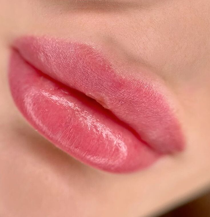 Phun môi collagen là gì? Có nên làm và ai phù hợp nhất