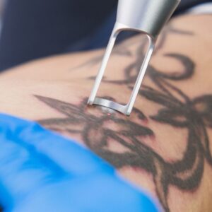 Xoá phun xăm bao nhiêu lần mới sạch? Sự thật 2026