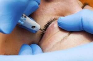 Xoá phun xăm 2026: Công nghệ Laser có còn tối ưu?