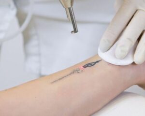 Xoá xăm bị thâm – Cách khắc phục 2026