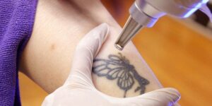 Xoá xăm không đau: Công nghệ lạnh 2026