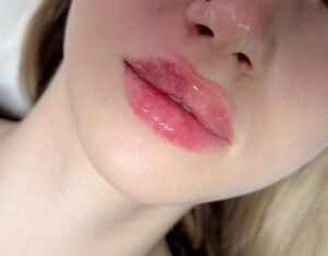 Phun môi xong nhưng mãi không bong là bị gì? Chuyên gia giải thích rõ