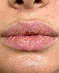 Phun môi cho môi khô nhăn có hiệu quả không?