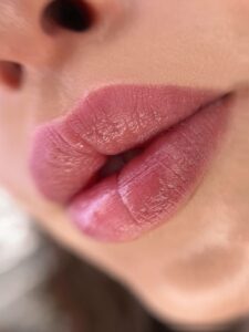 Vì sao môi bị thâm trở lại? Cách xử lý nhanh – an toàn – không đau