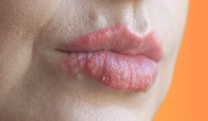 Phun môi bị mụn nước có sao không?