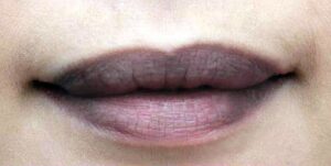 Môi thâm – nguyên nhân & giải pháp khử thâm lên màu chuẩn – hồng tươi tự nhiên chỉ sau 1 liệu trình