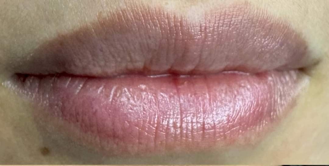 Phun môi bị thâm phải làm sao? Cách xử lý đúng chuẩn