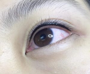 Kỹ thuật phun mí mở tròng có nguy hiểm không?