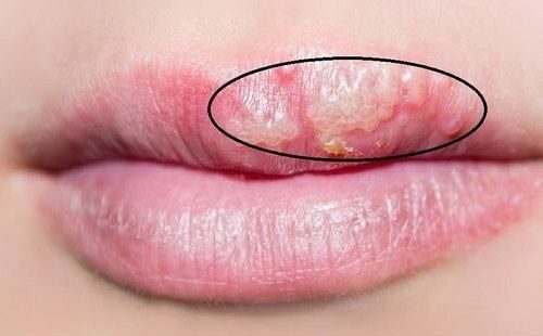 Phun xăm bị nhiễm trùng có nguy hiểm không? Cách phòng tránh hiệu quả 1 Phun xăm bị nhiễm trùng có nguy hiểm không? Cách phòng tránh hiệu quả