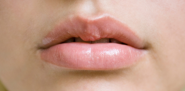 Cách khử thâm môi an toàn, không đau, không để lại sẹo – Hướng dẫn chi tiết 2025