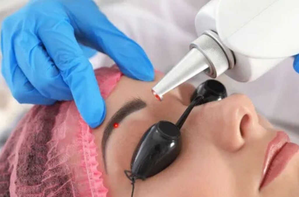 Xóa phun xăm bằng laser có còn là phương pháp tối ưu năm 2026?