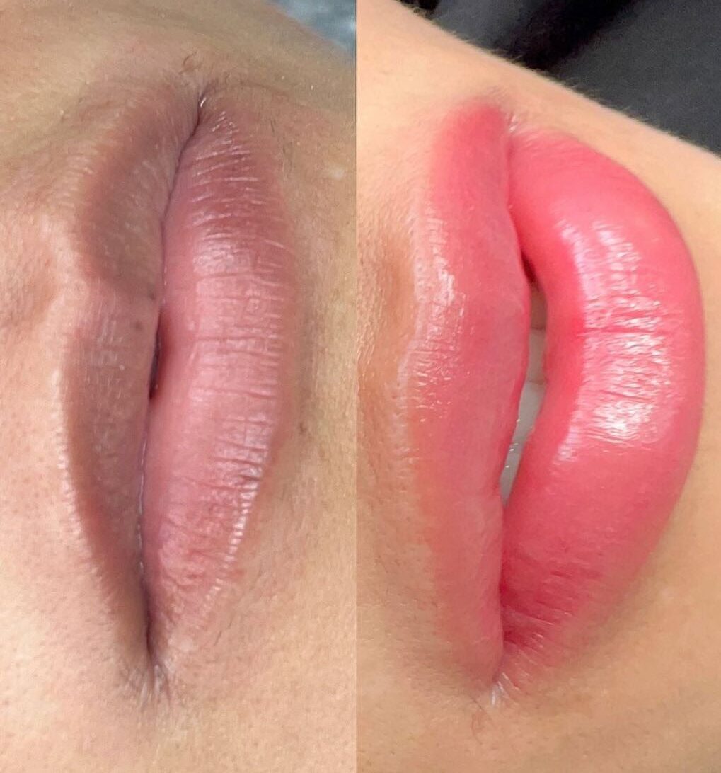 Nên khử thâm môi trước hay phun môi luôn? Chuyên gia giải đáp chi tiết